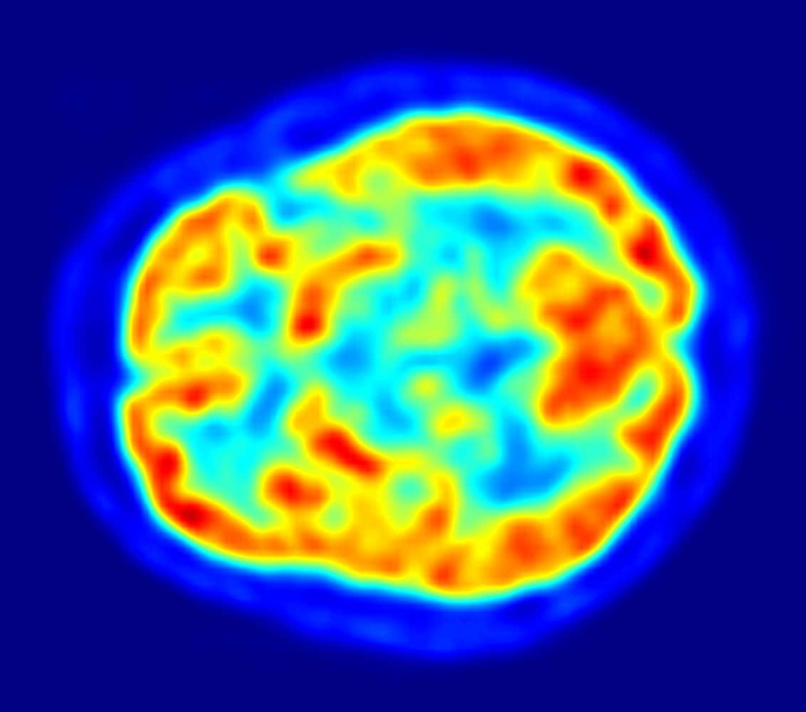 A PET image of a slice of human brain, showing areas of blue and red coloring. This method was used to measure depression-caused inflammation in this study.